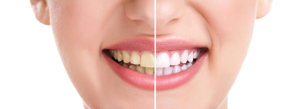 tooth whitening cosmetic dentist Rapid City